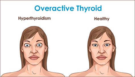 Hyperthyroidism Symptoms Diagnosis And Treatment Endocrinology