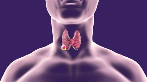 Thyroid Cancer Incidence Diagnosis And Treatment BroadcastMed