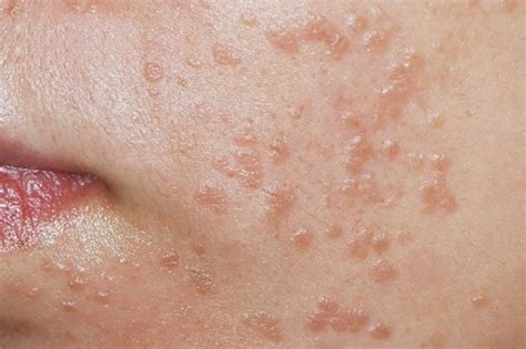 Flat Warts Causes Treatment And Prevention Hickey Solution
