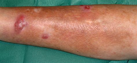 Manchas De Pele As 5 Causas Mais Comuns Artrite Reumatoide Zohal