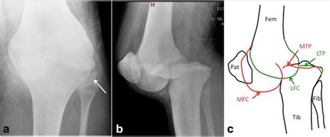 Plain Antero Posterior A And Lateral B Radiographs Of The Left Knee