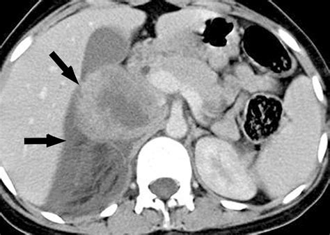 Spontaneous Rupture Of A Right Pheochromocytoma Axial Download