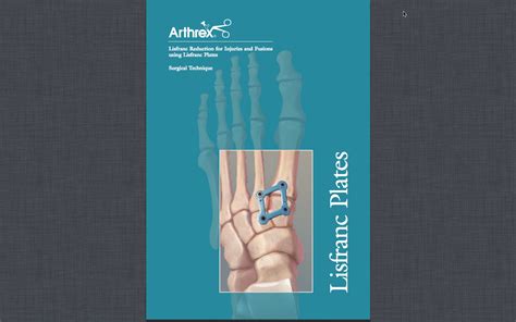 After Lisfranc Surgery New Technology For Lisfranc Injuries And Fusions