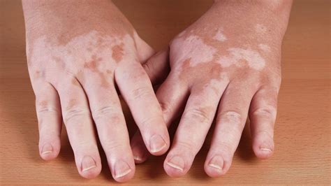 Can Vitiligo Lead To Skin Cancer Vitiligo Or Skin Cancer