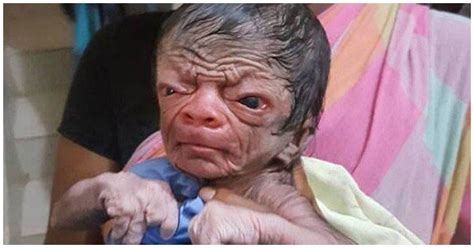 Baby With Rare Genetic Disorder Born In Bangladesh He Will Age 8 Times