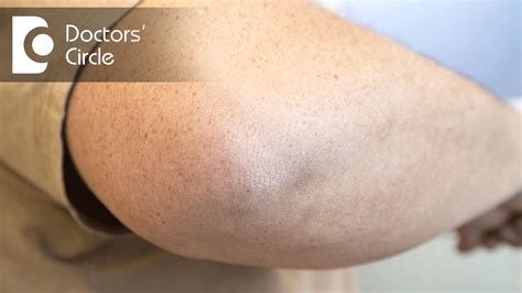 Bumps On Elbows Causes And Prevention Tips