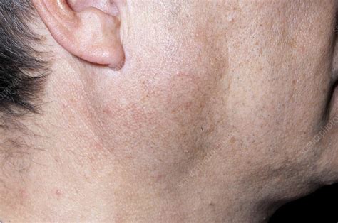 What Causes Swollen Parotid Glands Images And Photos Finder