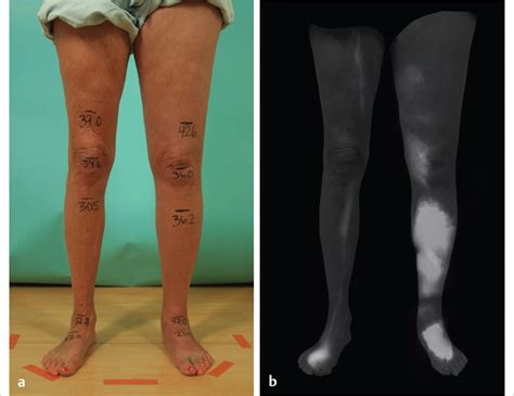 65 Surgical Treatments Of Lymphedema Plastic Surgery Key