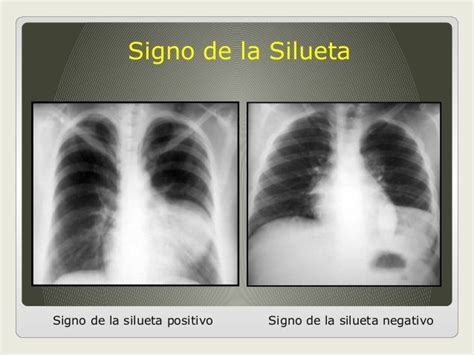 Signos Radiologicos De Torax Radiología Imagenologia Diagnostico