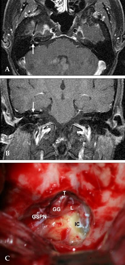 Mri And Operative Findings In A Patient With Ramsay Hunt Syndrome