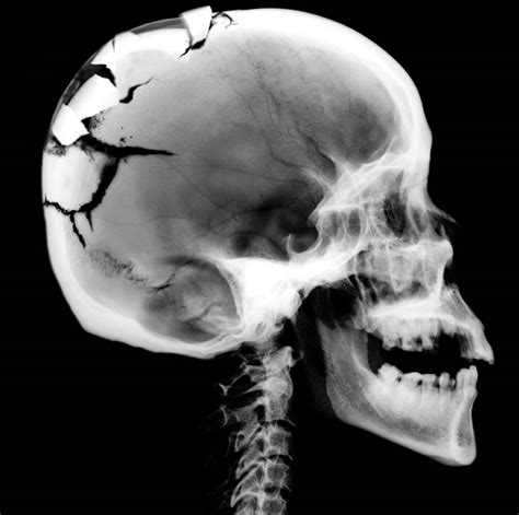 Gallery For Broken Skull X Ray