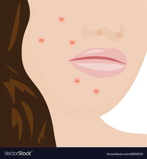 A Young Woman Having Acne Royalty Free Vector Image