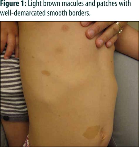Are light or dark brown patches that can be anywhere on the body; Cutaneous Features of Neurofibromatosis | healthPlexus.net