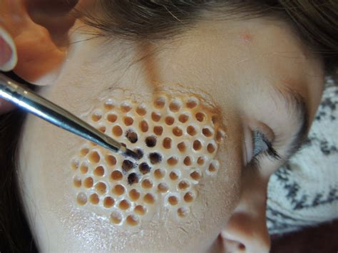 Trypophobia Skin Disease