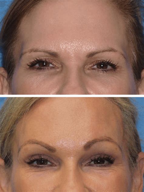 Brow And Forehead Lift Gallery Diepenbrock Facial Cosmetic Surgery In
