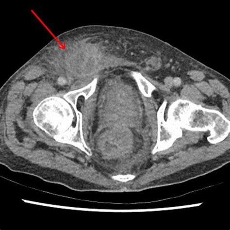 Findings For Low Type Imperforate Anus With Anocutaneous Fistula Are