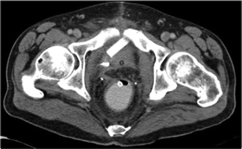 Axial Ct Scan With Rectal Contrast And Intravenous Contrast