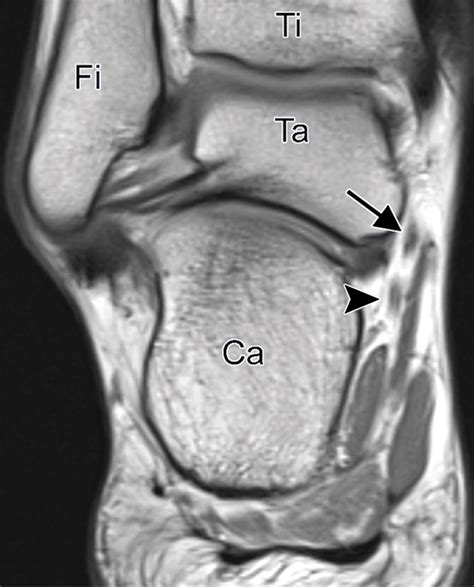 Normal Anatomy And Compression Areas Of Nerves Of The Foot And Ankle
