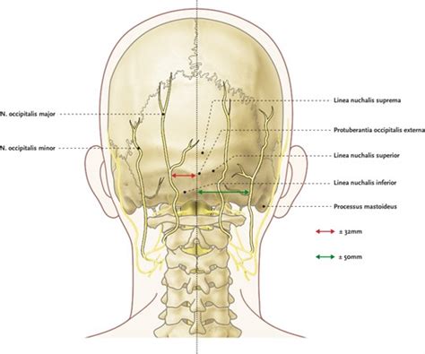Procedure Infiltration Of The Greater And Lesser Occipital Nerves