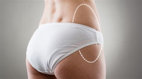 Hips Liposuction Cost Procedure And Results Before And After