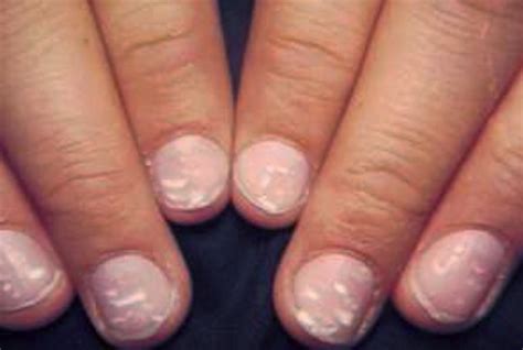 👉 White Spots On Nails Pictures Causes Treatment December 2021