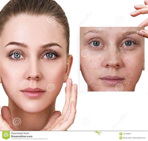 Woman Shows Photo With Bad Skin Before Treatment Stock Image Image