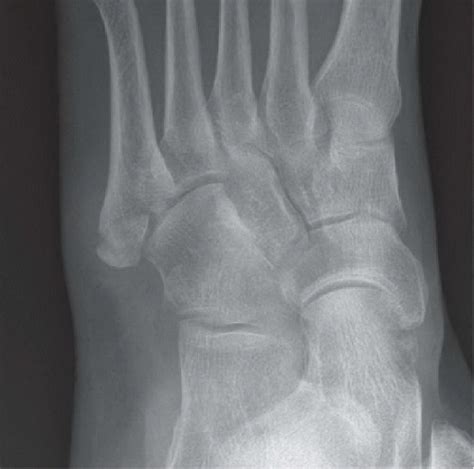 Base Of Fifth Metatarsal Fracture Radiology Key