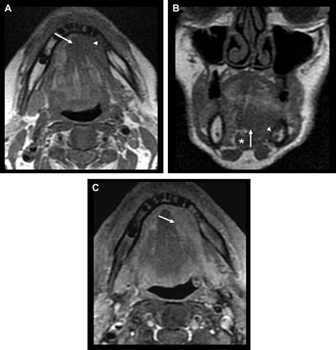 Pitfalls In The Staging Of Cancer Of Oral Cavity Cancer Neuroimaging