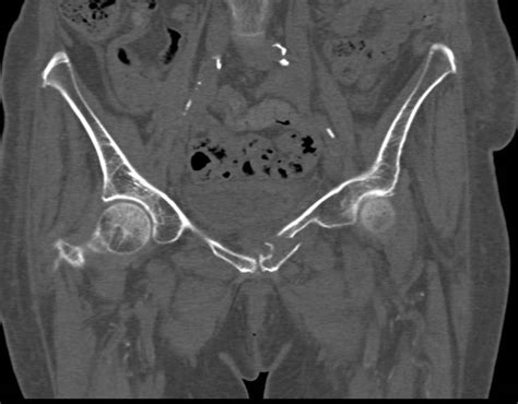 Fracture of the Left Superior and Inferior Pubic Ramus ...