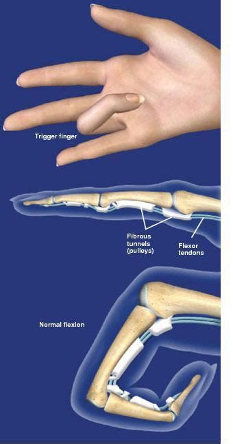 Trigger Digit Sarasota Fl Schofield Hand And Bright Orthopaedics