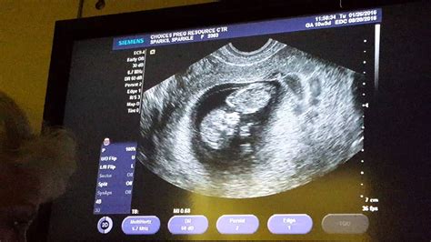 My Ultrasound At 10 Weeks Pregnant Baby Hardnett👣2016 Youtube