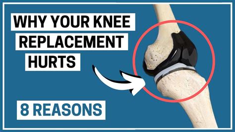 Why Is Your Knee Replacement Painful Possible Reasons Knee