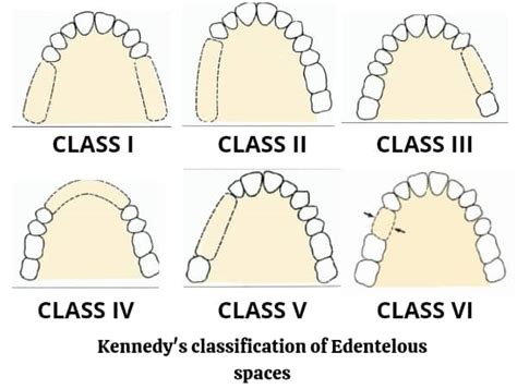 Kennedys Classification Of Edentulous Arch And Applegates Rules