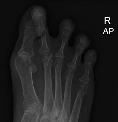 Anteroposterior Radiograph Of The Right Foot And Pre Operative Picture