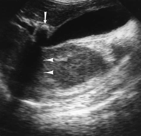 The Cystic Duct Normal Anatomy And Disease Processes Radiographics