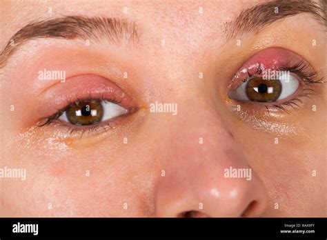 Close Up Picture Of Upper Eyelid Inflammation Chalazion Young