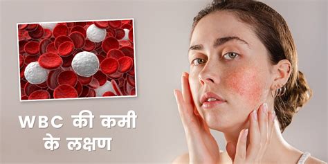 Symptoms Of Low White Blood Cells In Hindi व्हाइट ब्लड सेल्स Wbc की