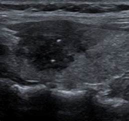 This Ultrasound Image Is Of A Solitary Thyroid Nodule The Nodule Is