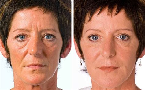 Non Surgical Facelift Hill Street Clinic