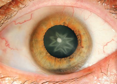 Cataracts Symptoms And Treatment Live Science
