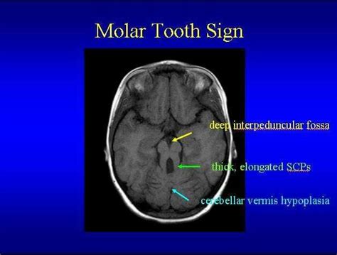 Joubert Syndrome Radiology Imaging Neurology Radiology