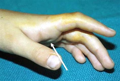 Verletzungen Der Hand Slideshow Medscape