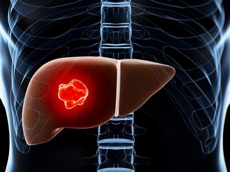 Liver Cancer Deaths Climb By Around 50 In The Last Decade Asian Fund
