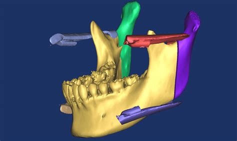 Guide For A Bone Cutting Line In Intraoral Vertical Ramus Osteotomy