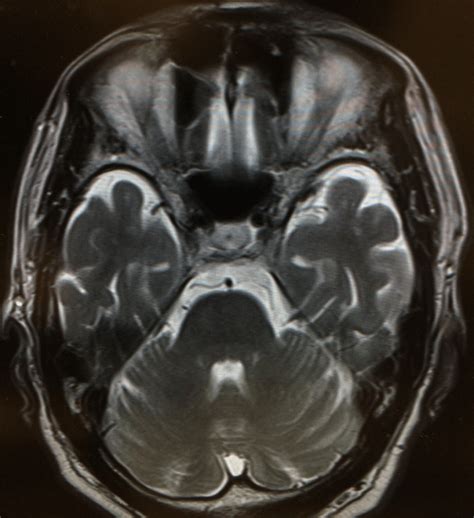 【ctmri画像あり】小脳の解剖学的位置を徹底解説！