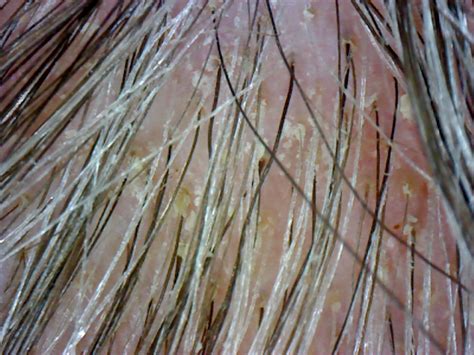 Morgellons Disease Awareness Morgellons Hair