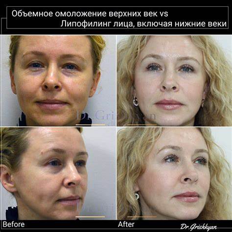 Похудеть за 30 дней джиллиан майклс отзывы фото до и после Липофилинг Верхних Век Фото До И После – Telegraph Липофилинг Верхних Век Фото До И После – Telegraph Похудеть за 30 дней джиллиан майклс отзывы фото до и после