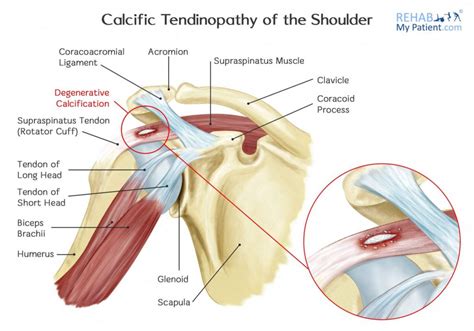 The nerves supply all the structures above and make them work. Calcification in your shoulder - shockwave can help | The ...
