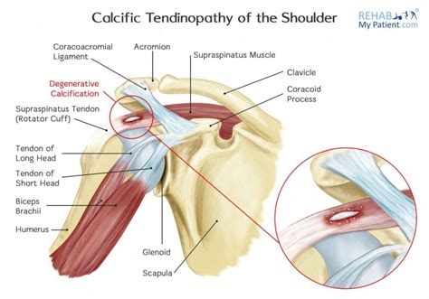 Infraspinatus and teres minor tendon. Calcification in your shoulder - shockwave can help | The ...