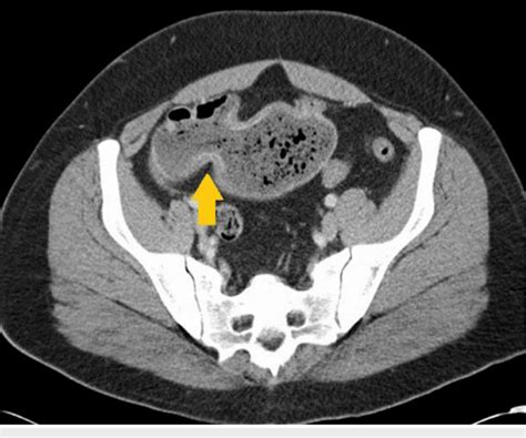 Contrast Enhanced Computed Tomography Ct Abdomenpelvis Showing A
